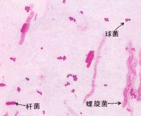 婦科白帶萝卜AV视频廠家分析白帶線索細胞陽性的意義
