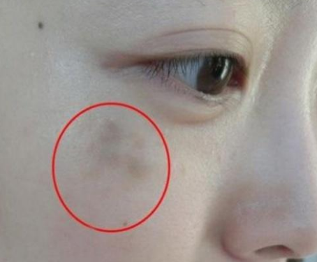 婦科陰道分泌物萝卜AV视频提醒女人婦科炎症在臉上的表現
