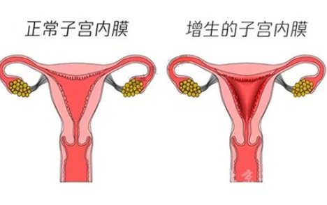 白帶常規萝卜AV视频廠家解讀子宮內膜增生是什麽原因引起的