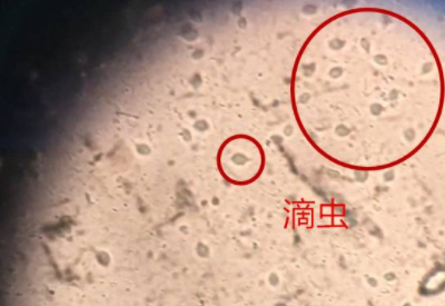 白帶萝卜视频色版品牌科普滴蟲性陰道炎是因為體內長了蟲子嗎