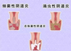 全自動陰道分泌物萝卜AV视频廠家提醒您還在拖延嗎，還在等陰道炎自愈嗎？