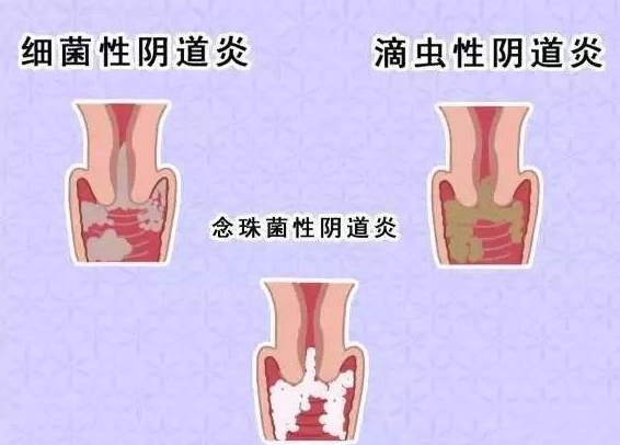 全自動陰道分泌物萝卜AV视频廠家提醒您還在拖延嗎，還在等陰道炎自愈嗎？